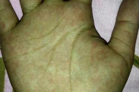 左耳畸形命理解析：命运不同，如何改运？