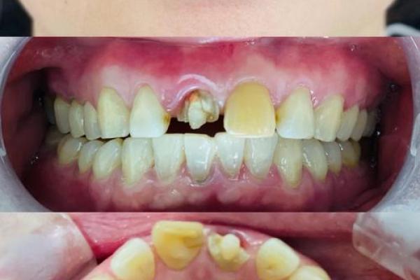 解析牙齿外伤与命运的关系：合婚时如何看待这一点？